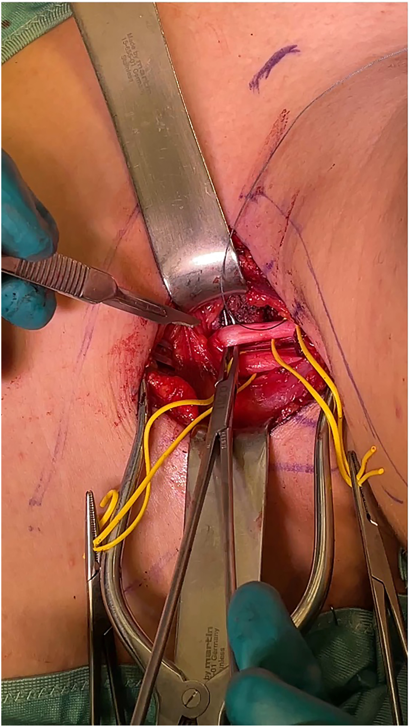 A surgical photo shows the dissection of the left spastic C 7 nerve root in the neck, exposed and prepared for transection to reduce ipsilateral spasticity.