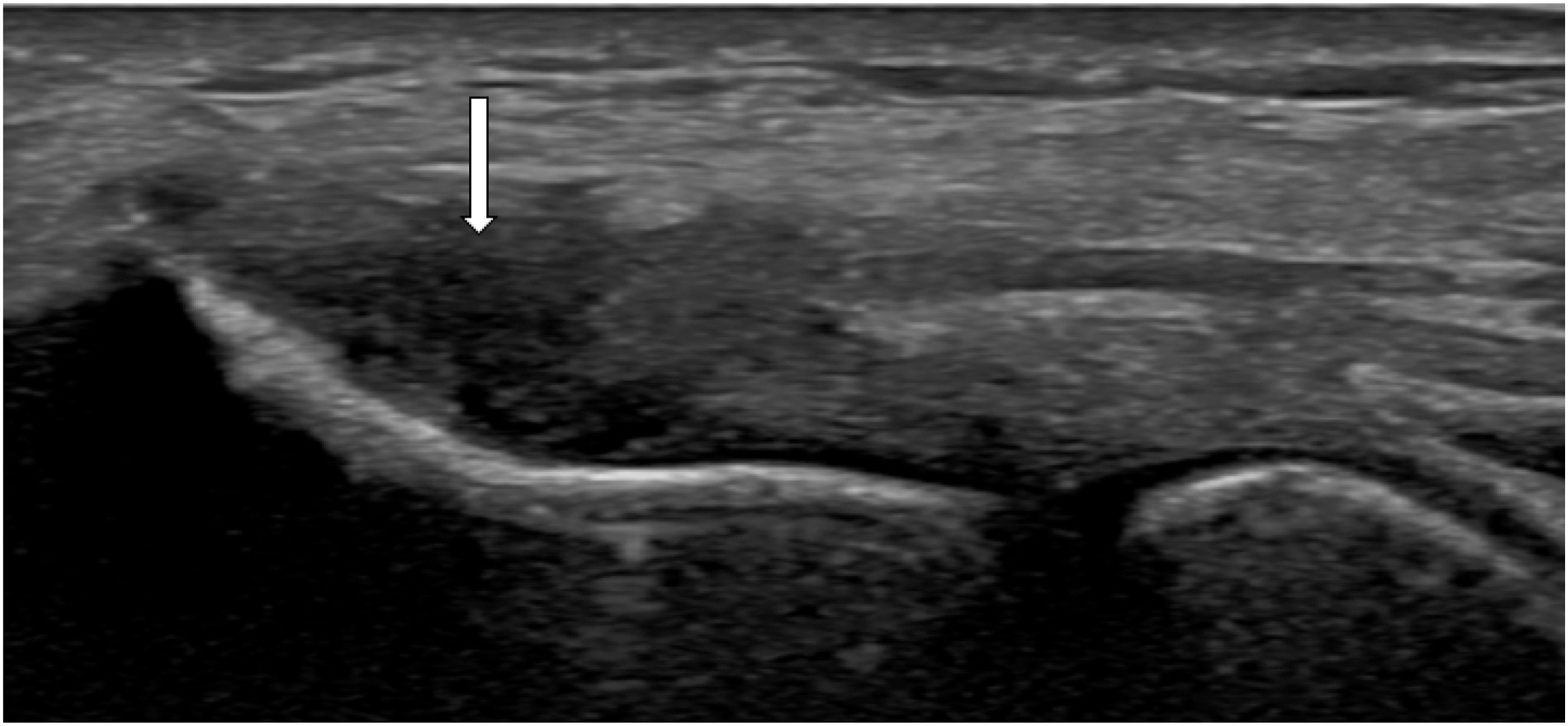 An ultrasound illustration shows lateral epicondylosis and a common extensor tendon tear in a wheelchair athlete, indicated by a white arrow in the long axis view.