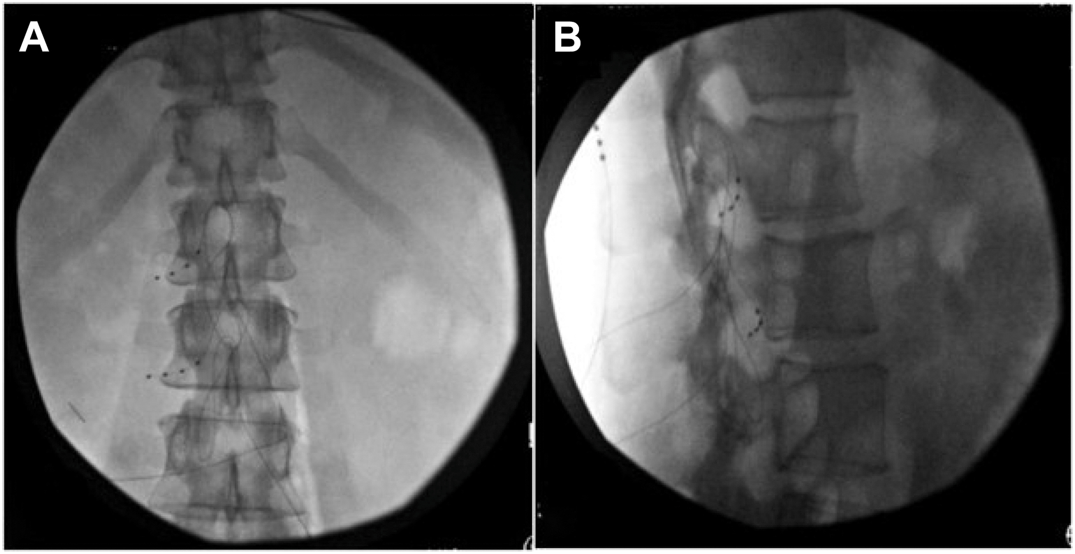 A two-panel fluoroscopic radiograph demonstrates the anteroposterior and lateral placement of dorsal root ganglion stimulation leads at the lumbar 1 and lumbar 2 vertebral levels.