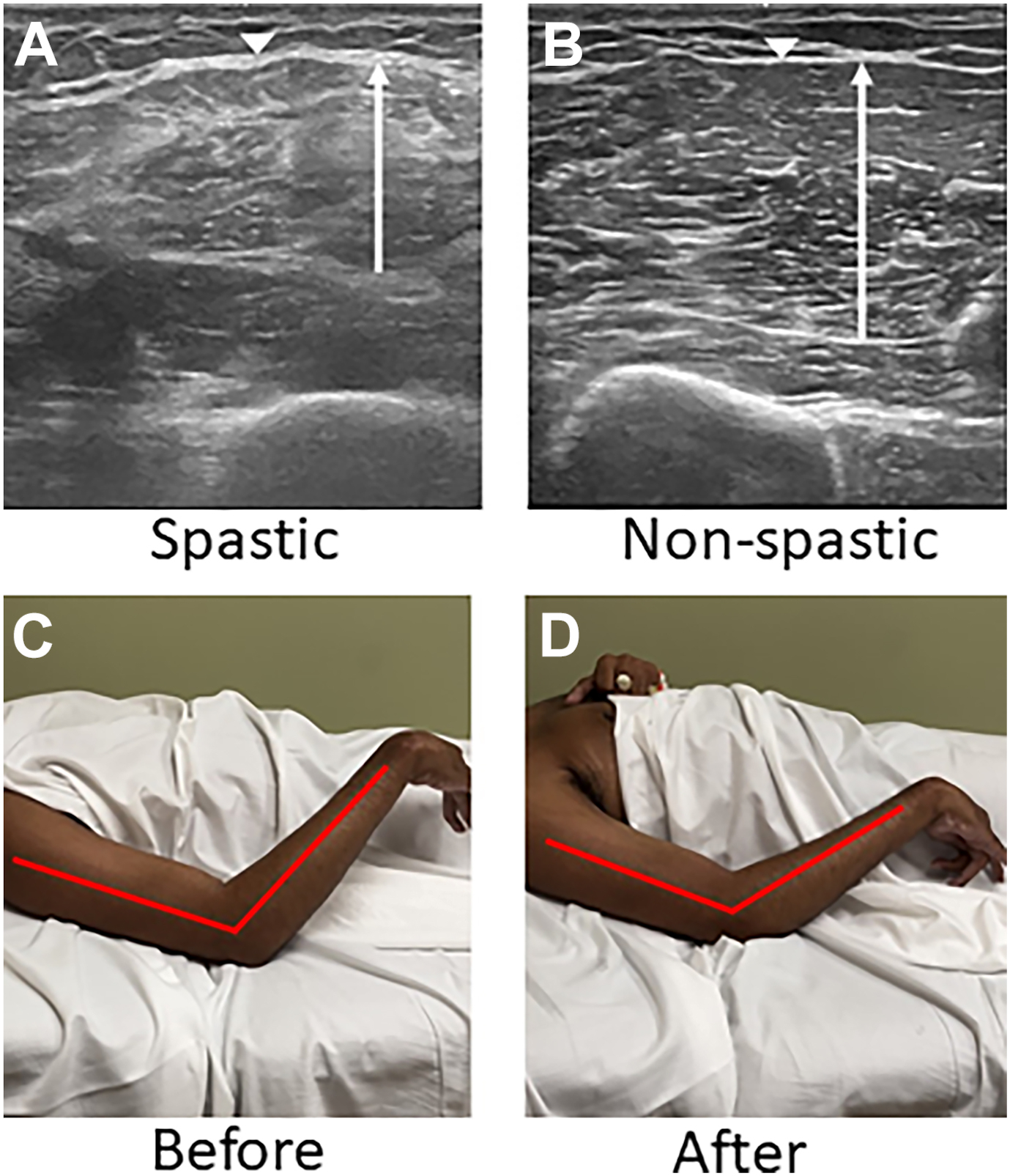 Four panels show ultrasound scans of spastic versus non-spastic biceps and photos of a patient’s elbow before and after fasciotomy with improved extension.