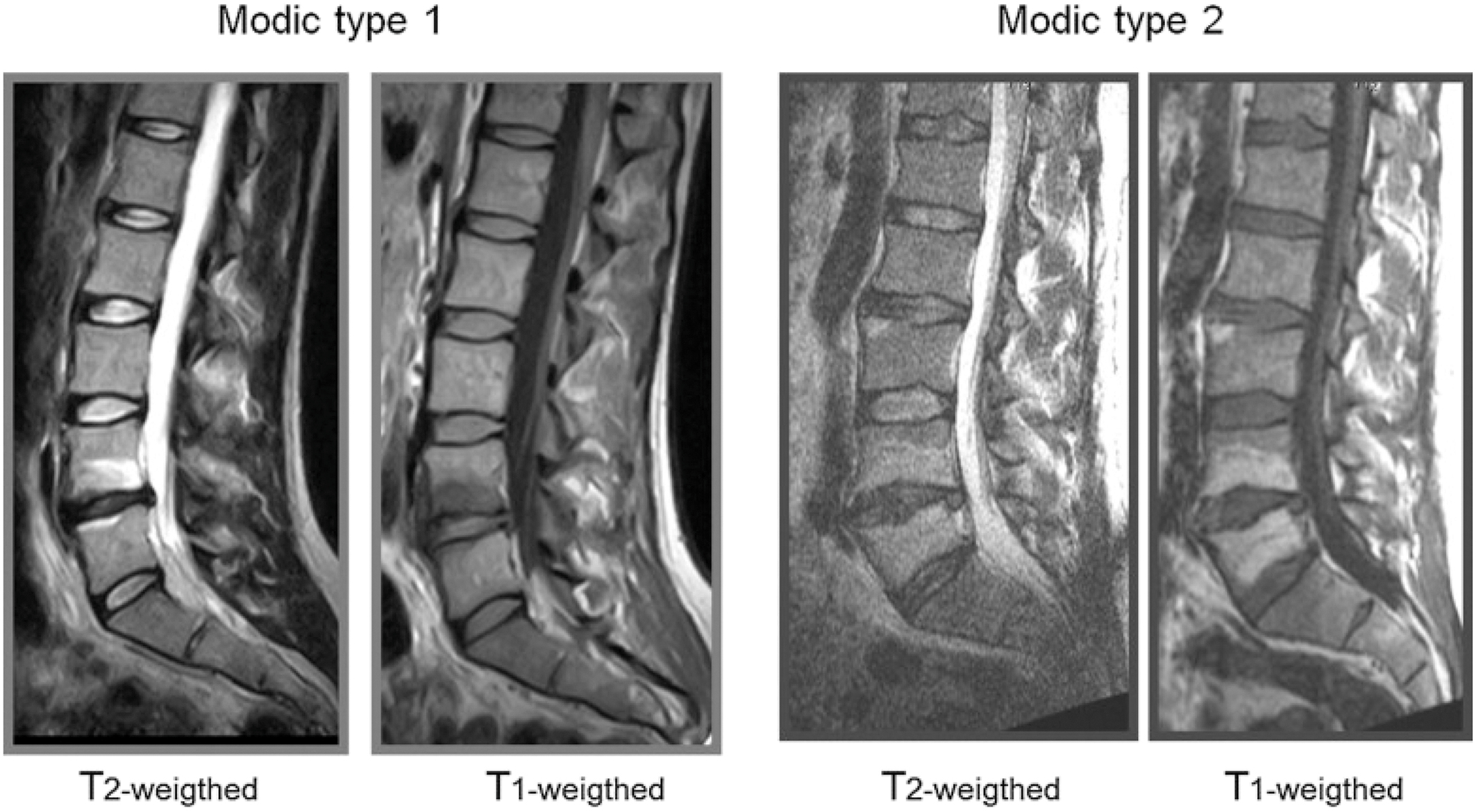 A set of four magnetic resonance imaging scans of the lumbar spine compares Modic type 1 and Modic type 2 vertebral endplate changes using both T 1 and T 2 weighted sequences.