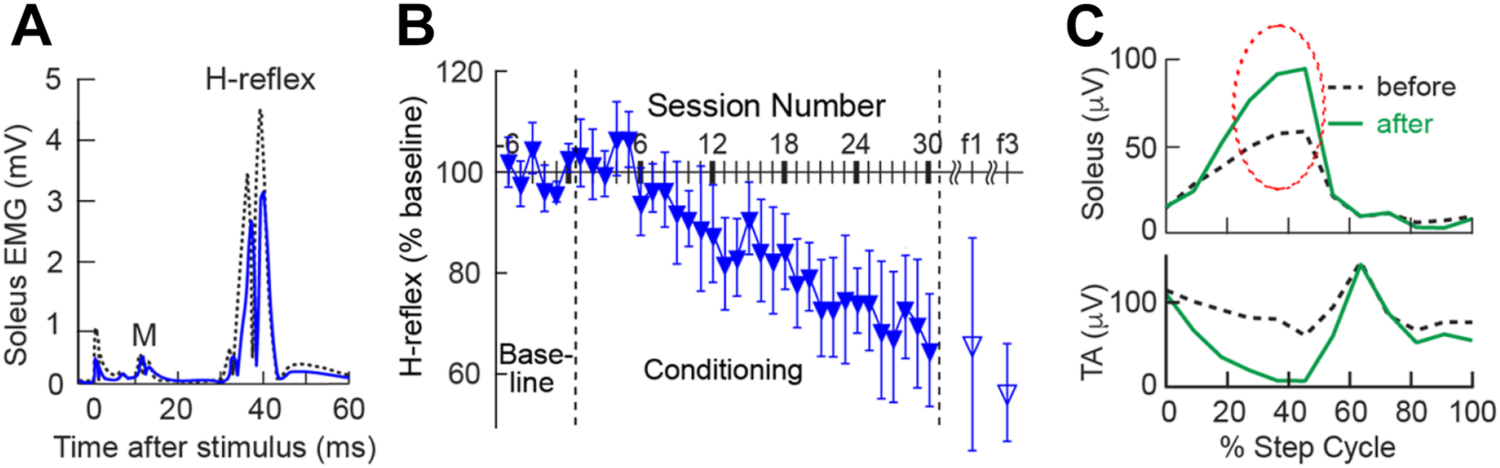 Three graphs illustrate reduced soleus H-reflex after down-conditioning and improved locomotor electromyography patterns in a person with chronic spinal cord injury.