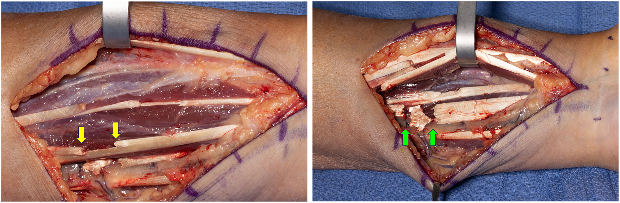 Two surgical photos show the fractional lengthening of the flexor digitorum superficialis and flexor digitorum profundus tendons in the forearm to increase muscle-tendon unit length.