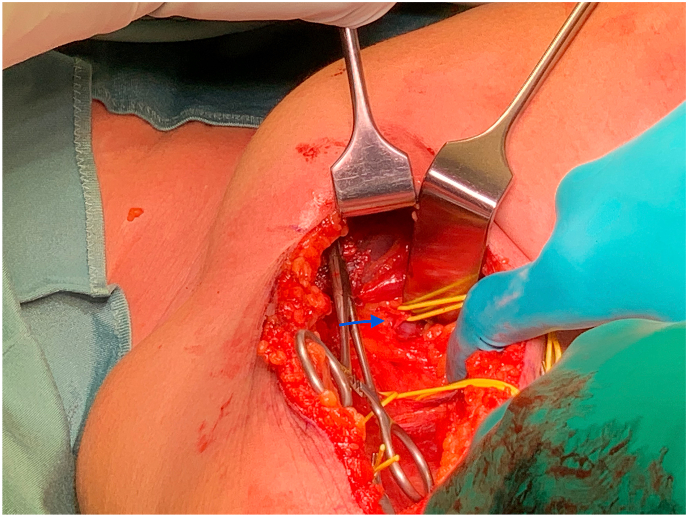 A surgical photo shows medial and lateral pectoral nerve branches to the pectoralis major exposed and marked for hyperselective neurectomy in spasticity.