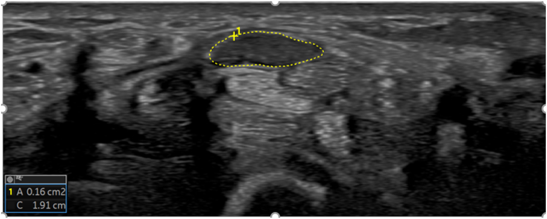 An ultrasound illustration showing carpal tunnel syndrome in a wheelchair athlete, with an increased median nerve cross-sectional area at the wrist.