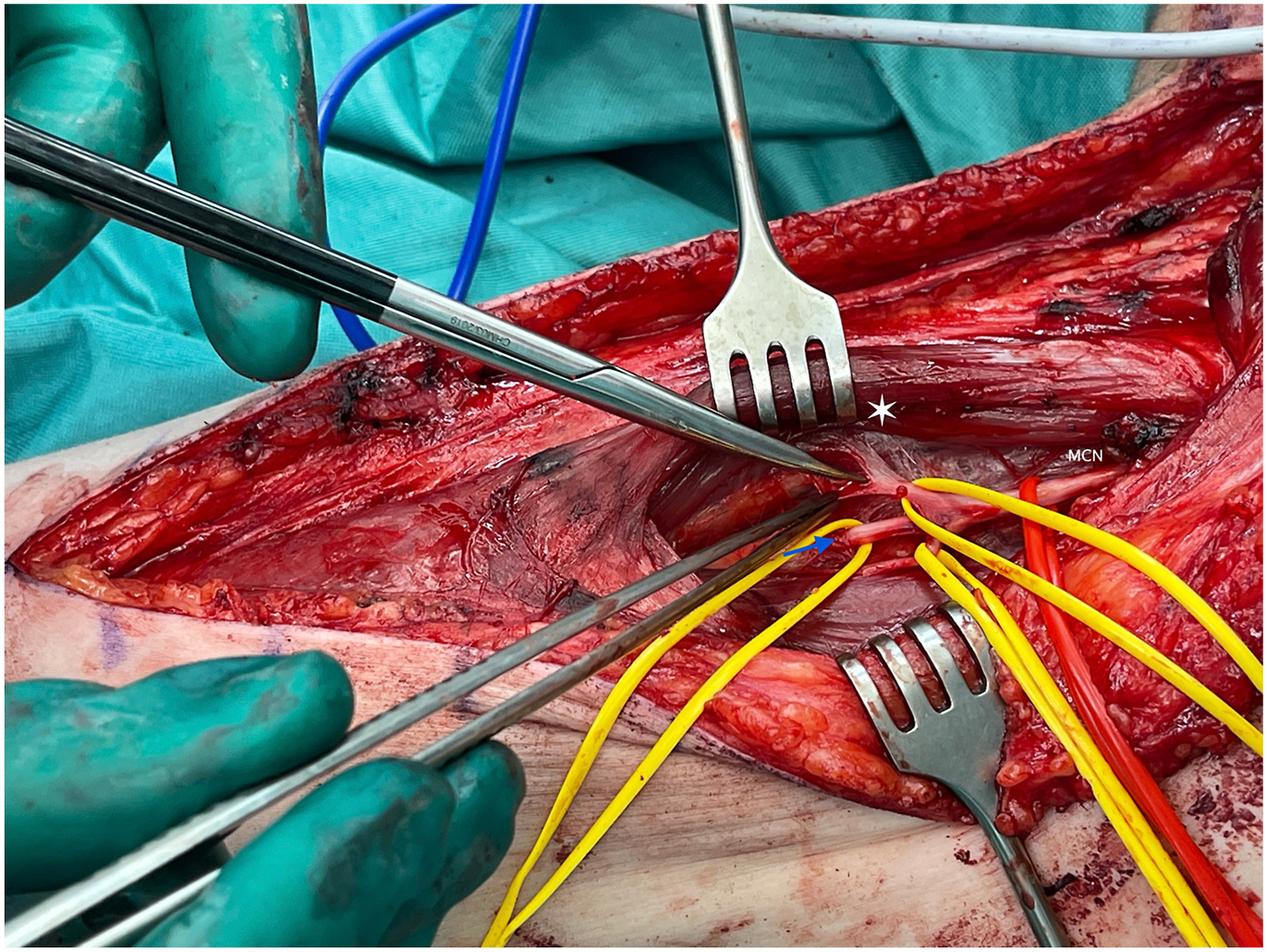 A surgical photo shows musculocutaneous nerve branches to the biceps and brachialis exposed for hyperselective neurectomy in the right arm.