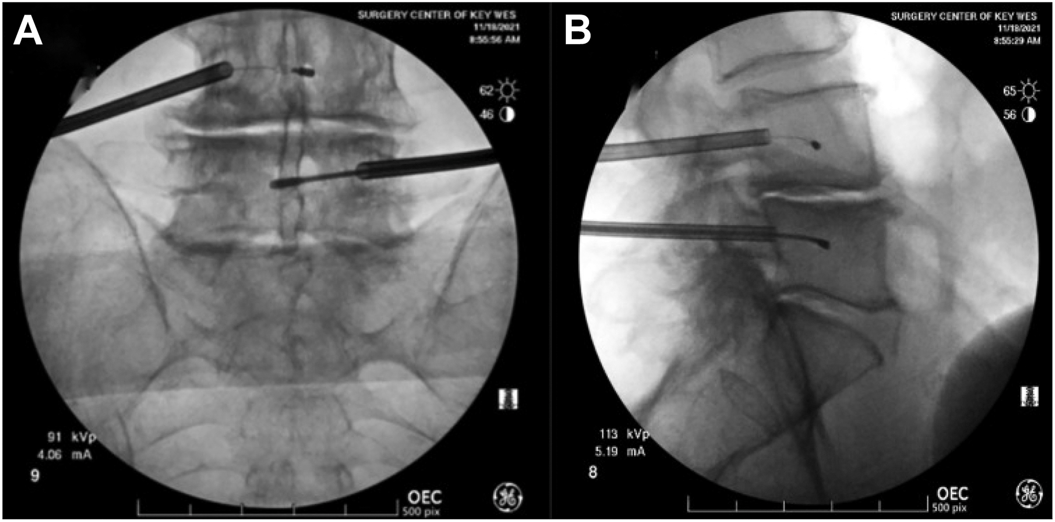 A set of two representative fluoroscopic X-rays shows the front and lateral views of a basivertebral nerve ablation procedure being performed at the lumbar 4 to lumbar 5 level.